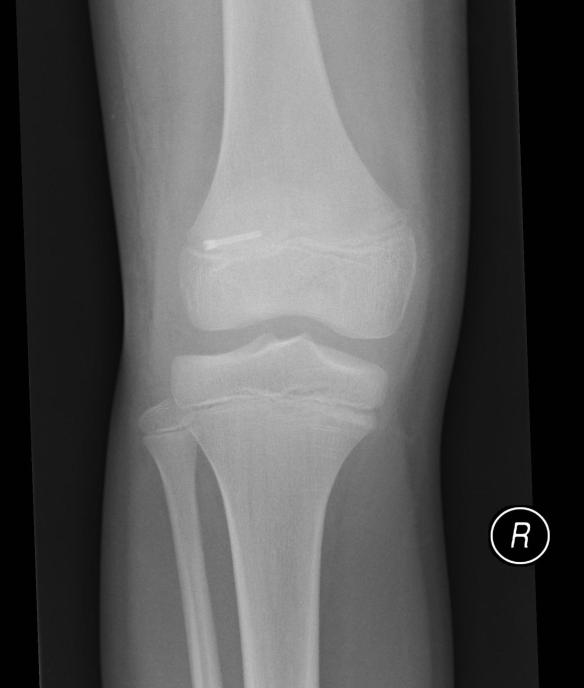 Z Metheringham XRay 20160413 1 copy