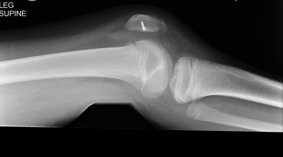 Z Metheringham XRay 20160413 2 copy